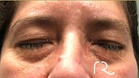 Eyelid Surgery Gallery - Patient 32619505 - Image 1