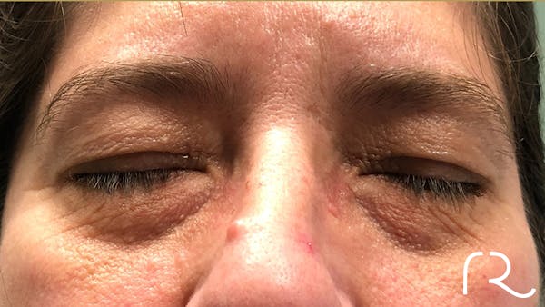 Eyelid Surgery Before & After Gallery - Patient 32619505 - Image 1