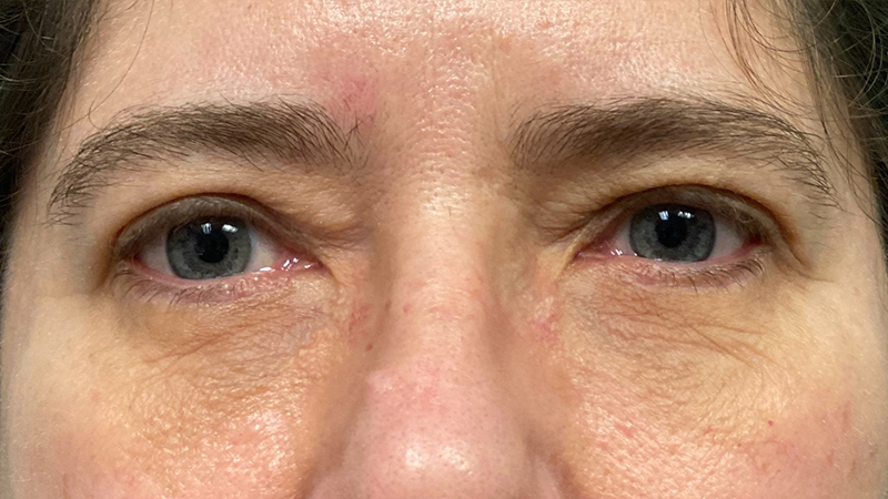 Eyelid Surgery Before & After Gallery - Patient 32619505 - Image 2