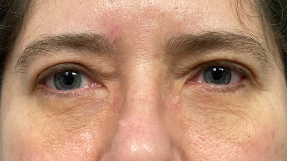 Eyelid Surgery Results