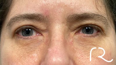 Eyelid Surgery Before & After Gallery - Patient 32619505 - Image 2
