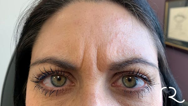 BOTOX, Dysport, Xeomin Before & After Gallery - Patient 32619603 - Image 1