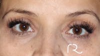 Brilliant Eyelid Lift (BEL Procedure) Before & After Gallery - Patient 32619637 - Image 1