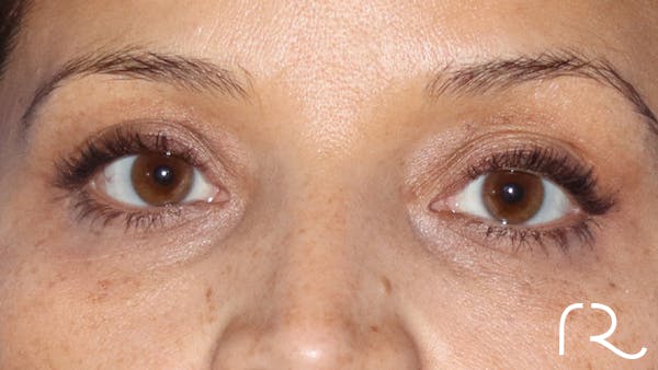 Brilliant Eyelid Lift (BEL Procedure) Before & After Gallery - Patient 32619637 - Image 2