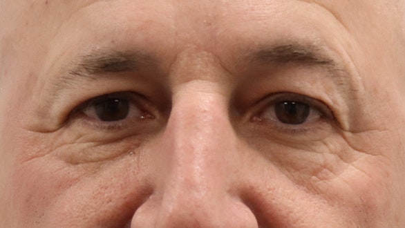 Male Eyelid Surgery Results