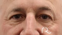 Brilliant Eyelid Lift (BEL Procedure) Before & After Gallery - Patient 32619638 - Image 1