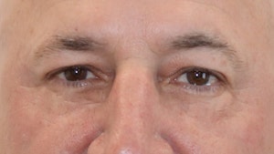 Male Eyelid Surgery Results