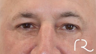 Brilliant Eyelid Lift (BEL Procedure) Before & After Gallery - Patient 32619638 - Image 2