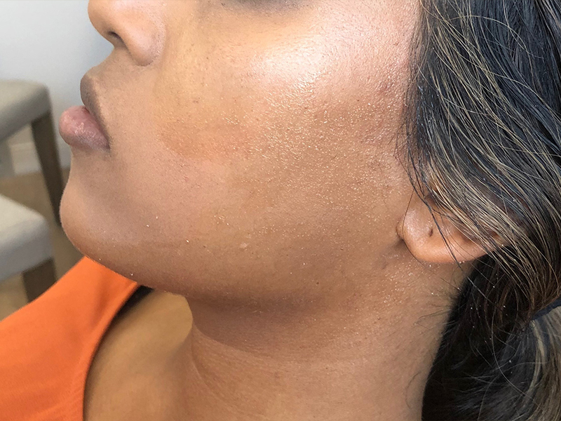 Dermal Fillers Before & After Gallery - Patient 32619661 - Image 1