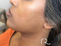 Dermal Fillers Before & After Gallery - Patient 32619661 - Image 1