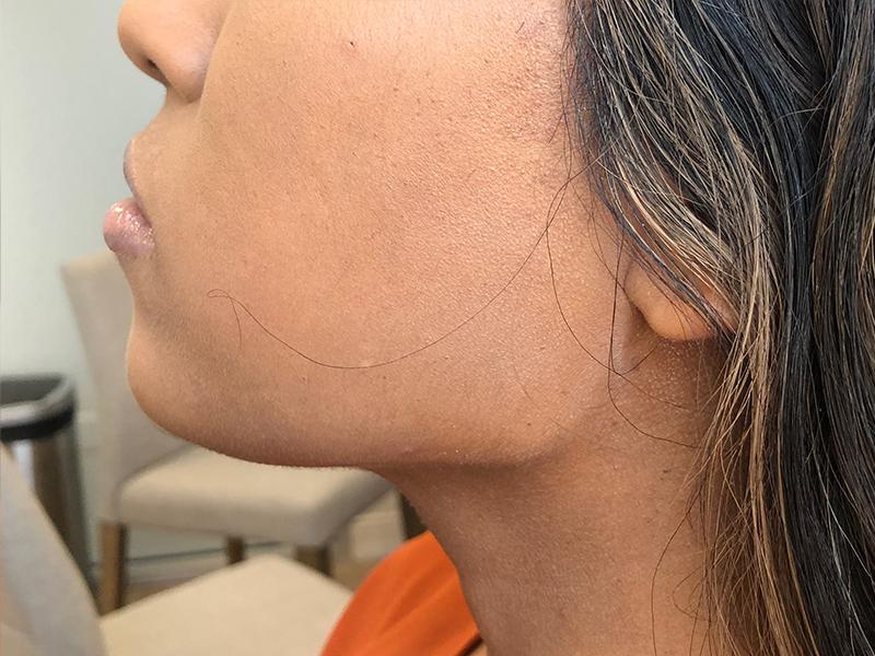 Dermal Fillers Before & After Gallery - Patient 32619661 - Image 2