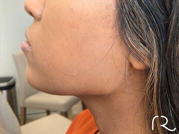 Dermal Fillers Before & After Gallery - Patient 32619661 - Image 2