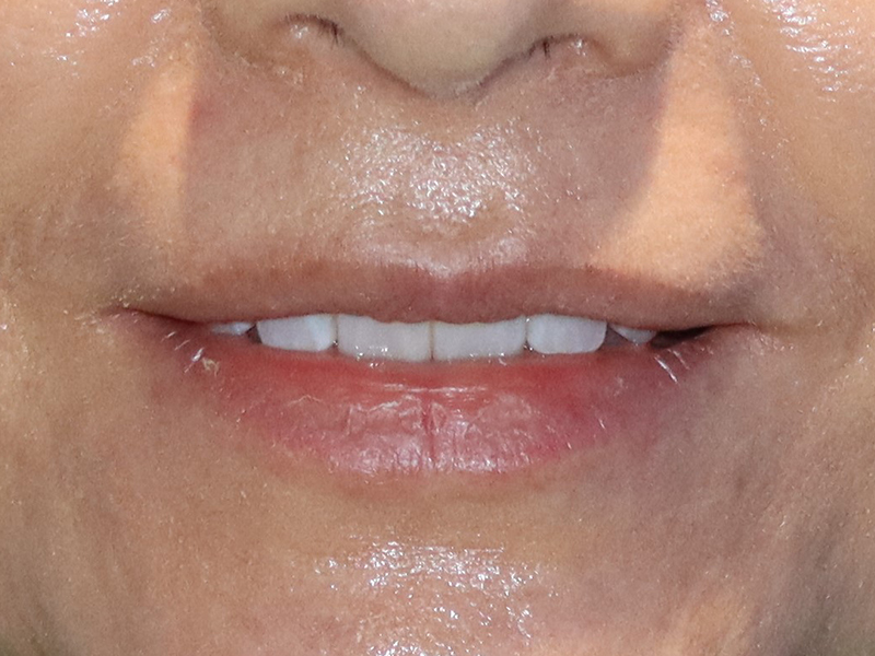 Dermal Fillers Before & After Gallery - Patient 32619662 - Image 1