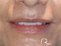 Dermal Fillers Before & After Gallery - Patient 32619662 - Image 1