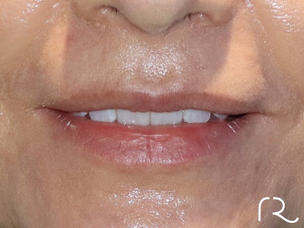 Dermal Fillers Before & After Gallery - Patient 32619662 - Image 1