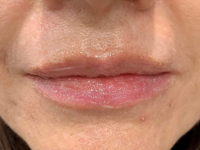 Dermal Fillers Before & After Gallery - Patient 32619662 - Image 2