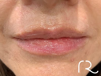 Dermal Fillers Before & After Gallery - Patient 32619662 - Image 2