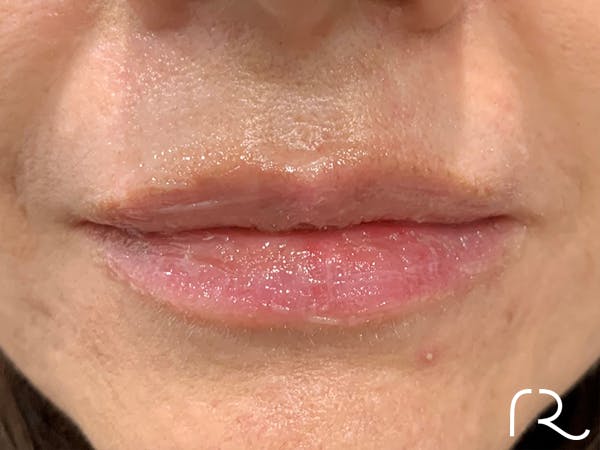 Dermal Fillers Before & After Gallery - Patient 32619662 - Image 2