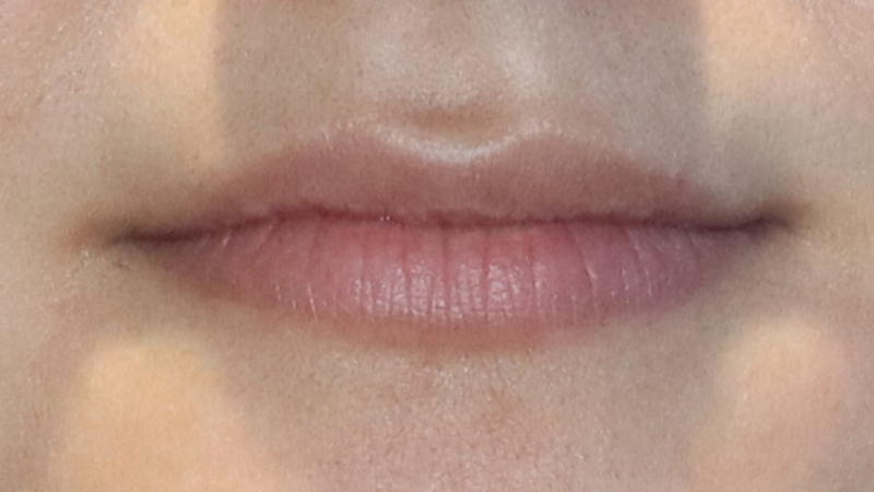 Dermal Fillers Before & After Gallery - Patient 32619663 - Image 1