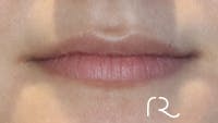 Dermal Fillers Before & After Gallery - Patient 32619663 - Image 1
