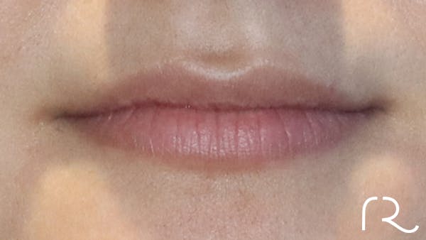 Dermal Fillers Before & After Gallery - Patient 32619663 - Image 1