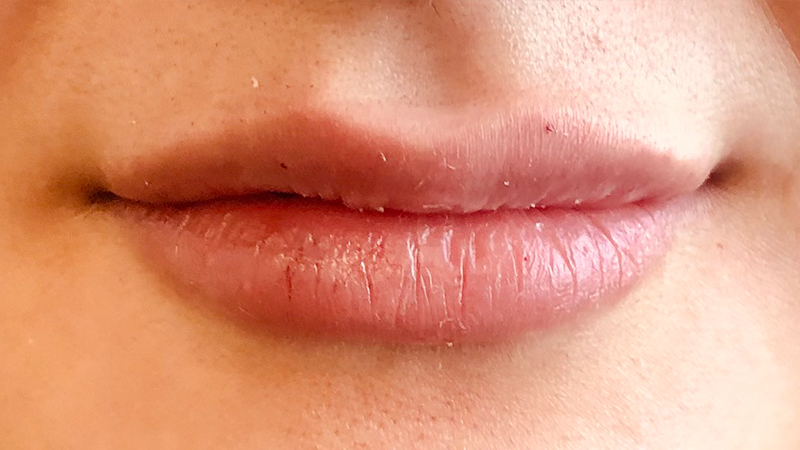 Before and after dermal fillers in McKinney TX at The Rana Center