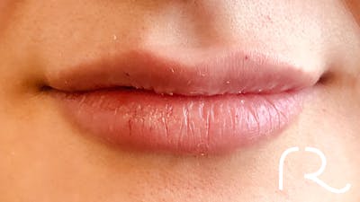 Dermal Fillers Before & After Gallery - Patient 32619663 - Image 2