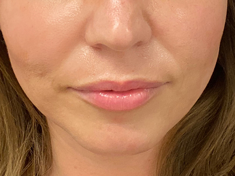 Dermal Fillers Before & After Gallery - Patient 32619664 - Image 1