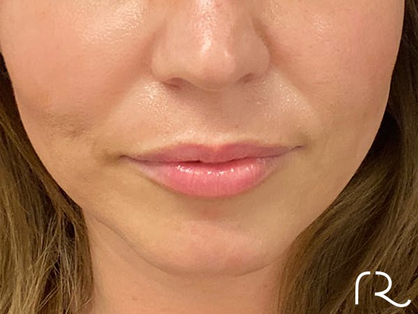 Dermal Fillers Before & After Gallery - Patient 32619664 - Image 1