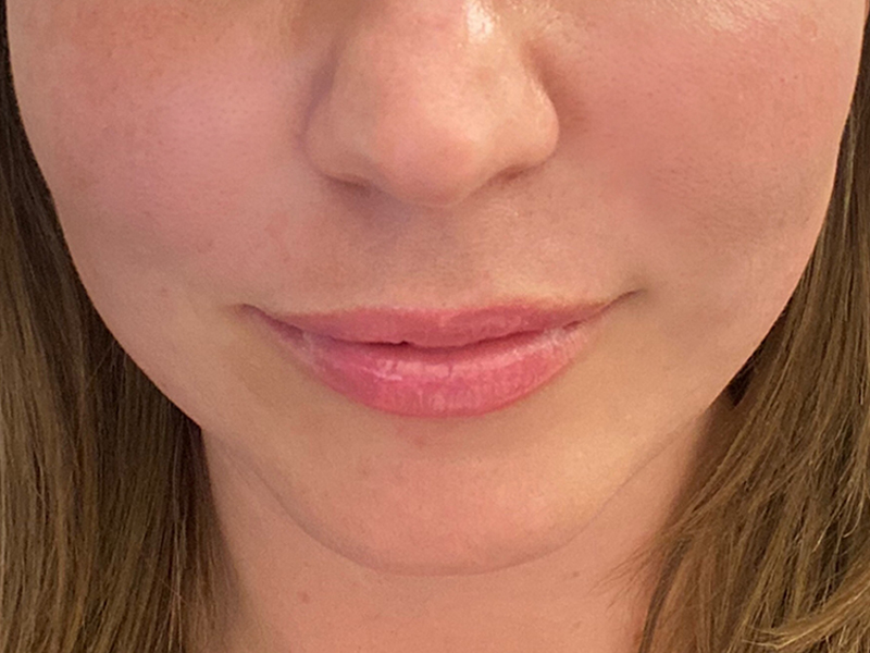 Dermal Fillers Before & After Gallery - Patient 32619664 - Image 2