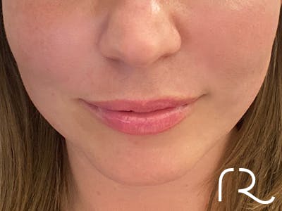 Dermal Fillers Before & After Gallery - Patient 32619664 - Image 2