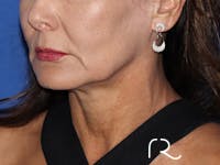 Neck Lift Before & After Gallery - Patient 116242953 - Image 1