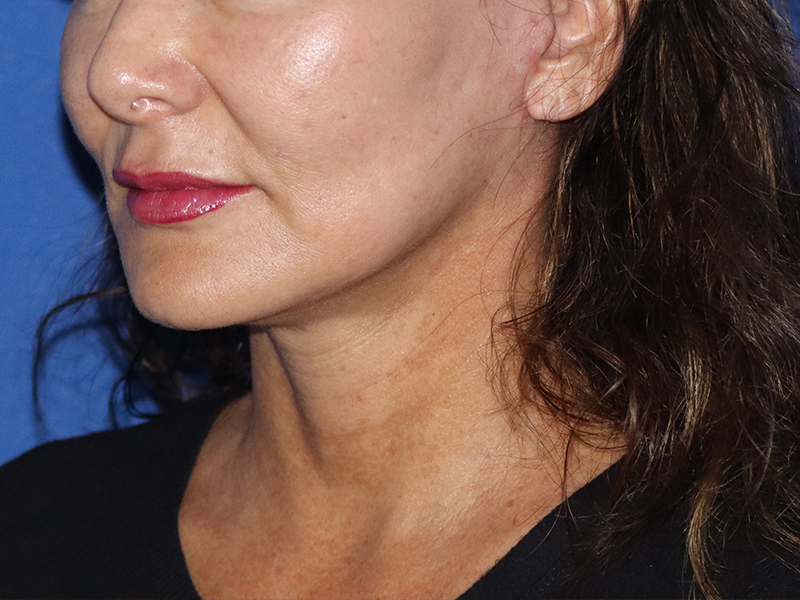 Neck Lift Before & After Gallery - Patient 116242953 - Image 2