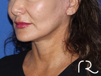 Facelift Before & After Gallery - Patient 116242827 - Image 2