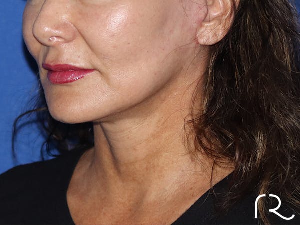 Neck Lift Before & After Gallery - Patient 116242953 - Image 2