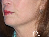 Neck Lift Before & After Gallery - Patient 116242954 - Image 1
