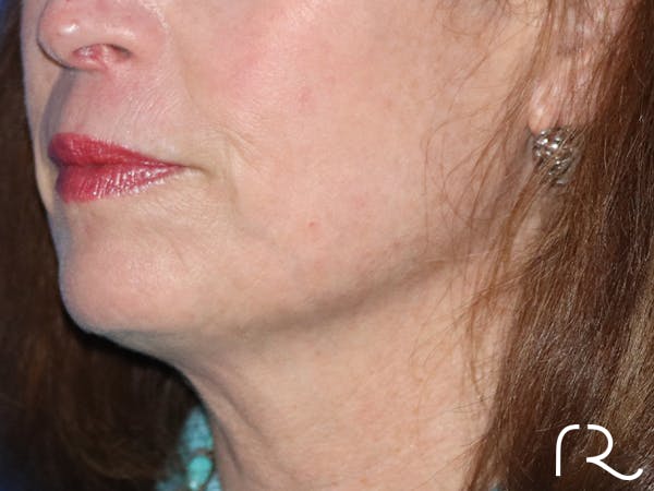 Facelift Before & After Gallery - Patient 116242828 - Image 1