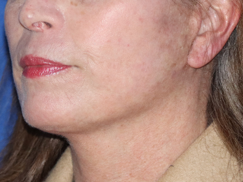 Facelift Before & After Gallery - Patient 116242828 - Image 2