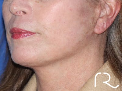 Neck Lift Before & After Gallery - Patient 116242954 - Image 2