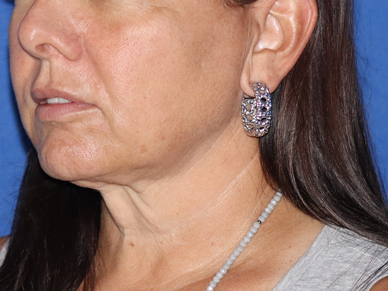 Neck Lift Before & After Gallery - Patient 116242955 - Image 1