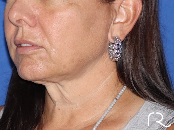 Facelift Before & After Gallery - Patient 116242829 - Image 1