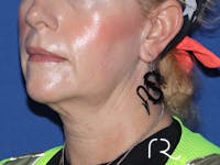 Neck Lift Before & After Gallery - Patient 116242956 - Image 1