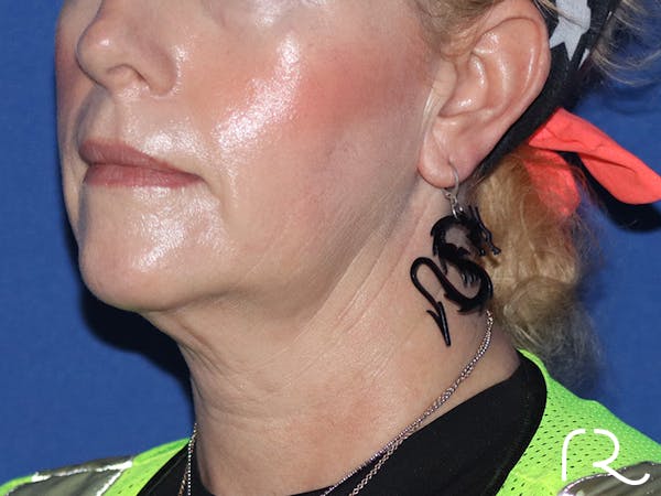 Facelift Before & After Gallery - Patient 116242830 - Image 1