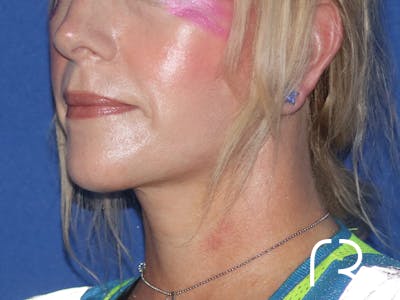 Facelift Before & After Gallery - Patient 116242830 - Image 2
