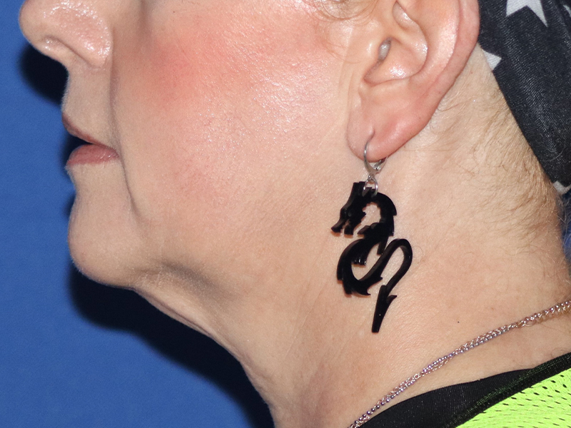 Facelift Before & After Gallery - Patient 116242830 - Image 3