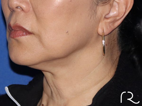 Neck Lift Before & After Gallery - Patient 116242957 - Image 1