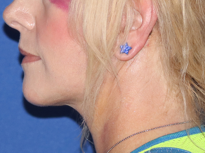 Facelift Before & After Gallery - Patient 116242830 - Image 4