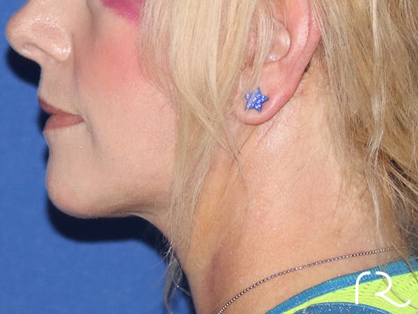 Facelift Before & After Gallery - Patient 116242830 - Image 4