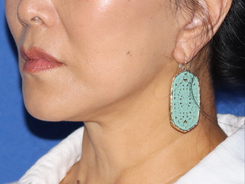 Facelift Before & After Gallery - Patient 116242831 - Image 2