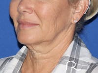 Neck Lift Before & After Gallery - Patient 116245932 - Image 1